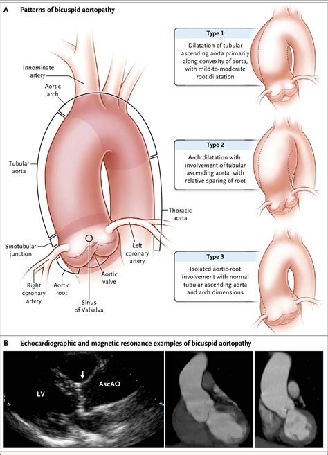 Figure 1 From Aortic Dilatation In Patients With Bicuspid Aortic Valve Semantic Scholar