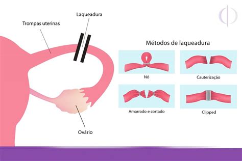 Como Fazer Laqueadura Pelo Sus Gratuitamente Entenda