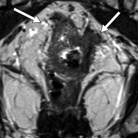 Rectal Imaging Part 1 High Resolution Mri Of Carcinoma Of The Rectum