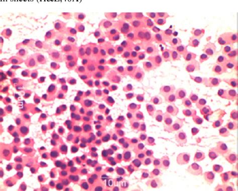 Figure 1 From Fine Needle Aspiration Cytology Of Salivary Gland