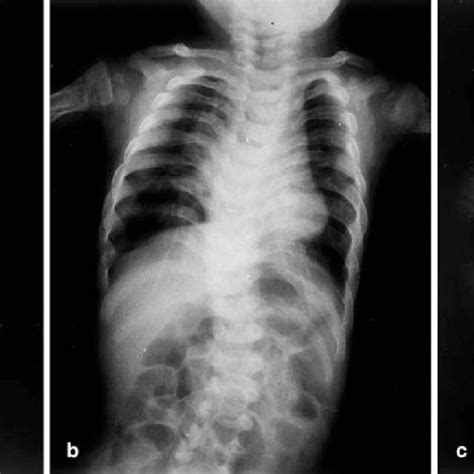 Pdf A Case Of I Cell Disease Mucolipidosis Ii Presenting With