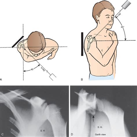 Radiographic Evaluation Of Shoulder Problems Musculoskeletal Key