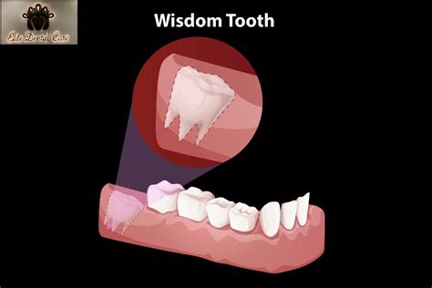 What Happens During Wisdom Teeth Extraction Elite Dental Care Tracy