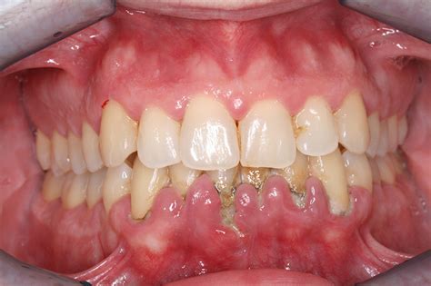 Enajenar árabe estético que es una bolsa periodontal Experto partícula