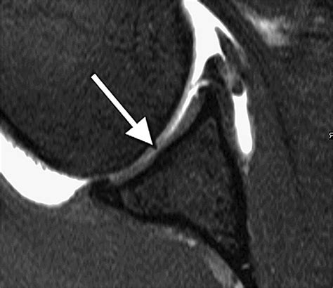 Axial Image At The Middle Level Of The Glenoid Shows The Tubercle Of Download Scientific