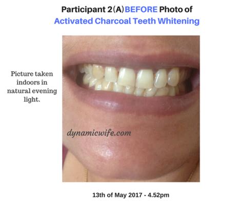 Activated Charcoal Teeth Whitening Experiment 2 Real Beforeafter Pics