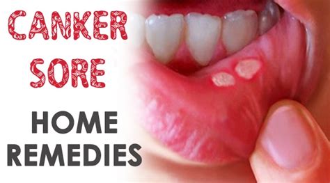 Canker Sore Home Remedies | Health Care | Getinfopedia