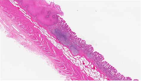 Esophagus stomach junction stock photo. Image of anatomy - 18698196