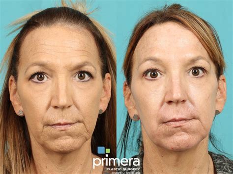 Laser Skin Resurfacing Dot Co2 Before And After Pictures Case 822