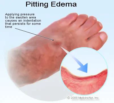 Causes Of Swollen Ankles In Diabetics - DiabetesWalls