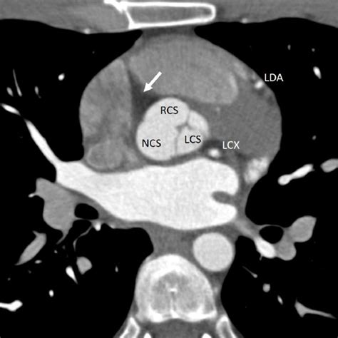 Source Images In The Axial Plane At The Level Of The Aortic Root Download Scientific Diagram