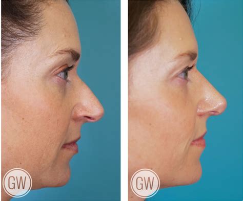 Rhinoplasty Gallery - Rhinoplastyperth