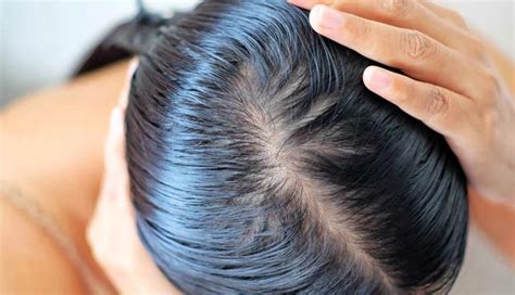 How To Treat Scabs On The Scalp