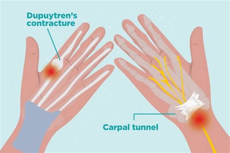 Causes and Overcome Stiff Finger Joints - HealthRemedy123 | Easy Health ...