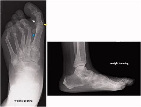 Preoperative X-ray of the affected foot. The MTP-1 joint is fused in ...