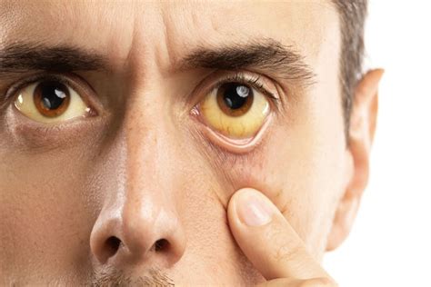 Jaundice Yellow Eyes Causes And Treatment