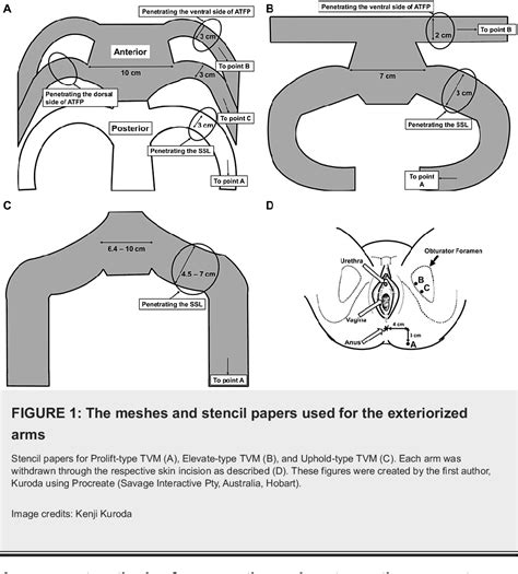 Figure 1 From Favorable Postoperative Outcomes After Transvaginal Mesh