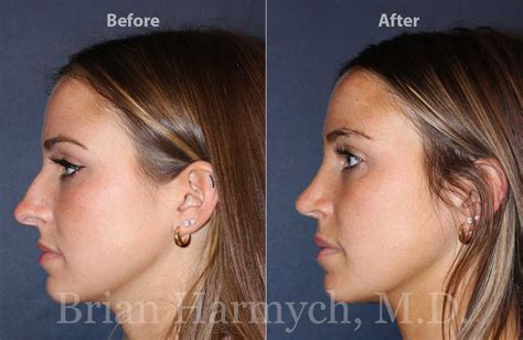 Good Rhinoplasty Before And After