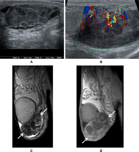 Angioleiomyoma In A 63 Year Old Man A And B Sonogram A Showing A Download Scientific