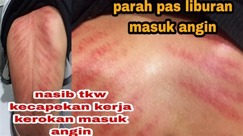 Kasihan Kerokan Full Punggung Sampai Merah Tkw Pas Liburan Masuk