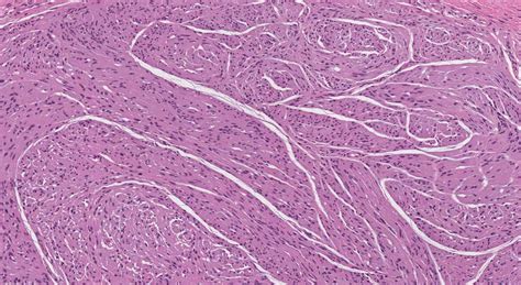 Circumscribed Solitary Neuroma Ottawa Atlas Of Pathology