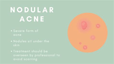 The 8 Types Of Acne And How To Treat Them Goodglow