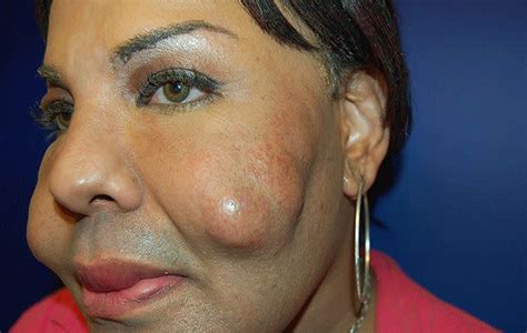 Transgender Victim Of Toxic Plastic Surgery Shows Off Her New Face