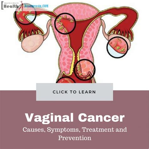 Signs And Symptoms Of Vaginal Cancer Cancerwalls