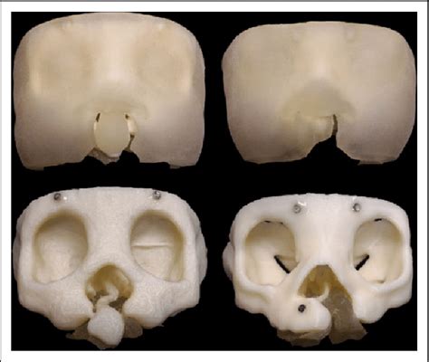 Frontal View Of 3d Models Of Bilateral Cleft Lip Palate Left Column Download Scientific