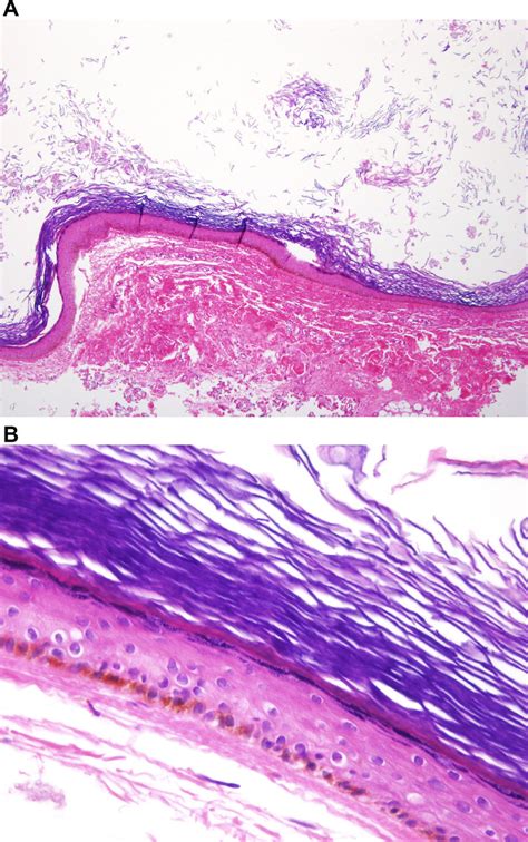 A B Histopathologic Examination Shows That The Cyst Is Lined By