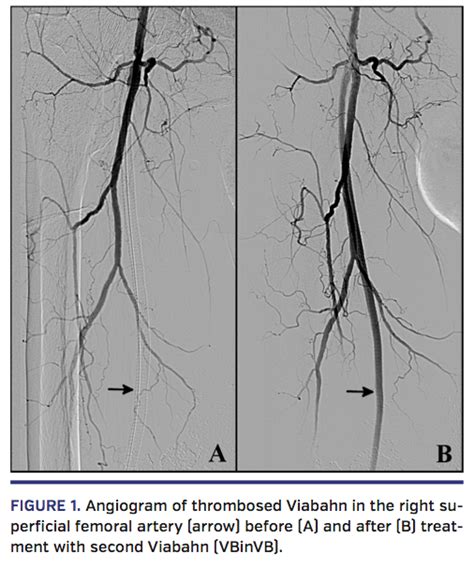 Percutaneous Treatment Of Stent Graft Viabahn Thrombosis Employing A