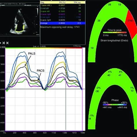 Two Dimensional Left Atrial Speckle Tracking Analysis For The