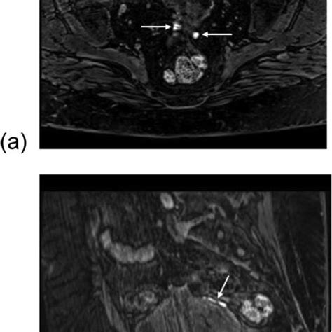 Magnetic Resonance Imaging Of The Pelvis Axial A And Sagittal B Download Scientific