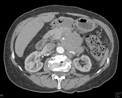 Pancreatic Adenocarcinoma With Bulky Adenopathy And Vascular Invasion