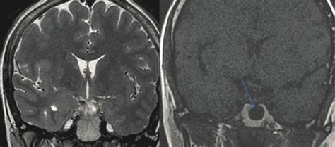 Interasellar Arachnoid Cyst 31 Years Woman Secondary Amenorrhea With Download Scientific