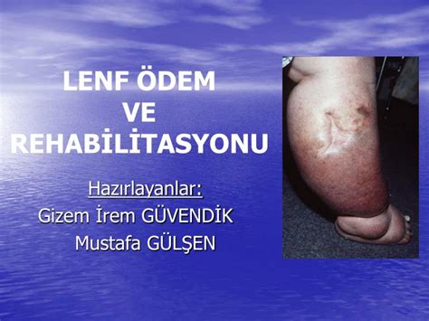 Ppt Lenf Dem Ve Rehab L Tasyonu Powerpoint Presentation Free