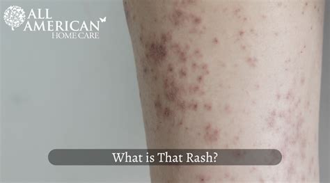 What is that Rash? - ALL AMERICAN HOME CARE