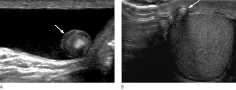 Ultrasonography Of The Scrotum In Adults Abstract Europe Pmc