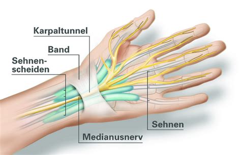 Carpaltunnelsyndrom CTS FOI Praxis Basel Liestal