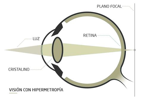 Hipermetrop A Qu Es Y Tratamiento Cl Nica Rahhal Valencia