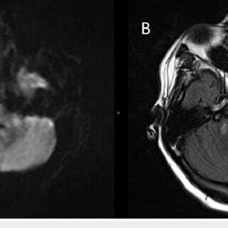 Axial Diffusion Weighted Imaging B1000 Demonstrating Restricted