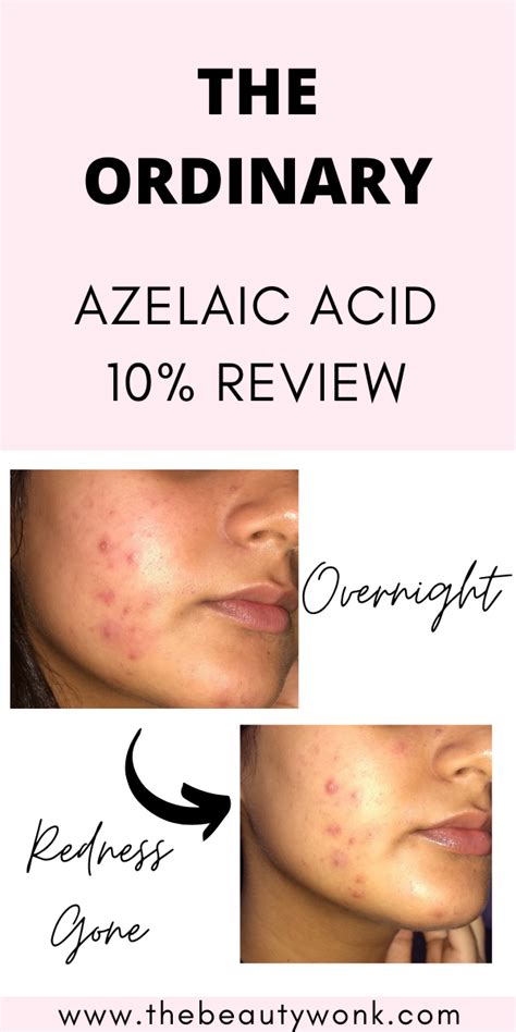 The Ordinary Azelaic Acid Suspension Review The Beauty Wonk The