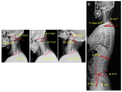 Jcm Free Full Text Analysis Of Cervical Spine Alignment And Its Relationship With Other