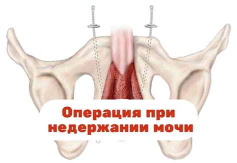 Операция при недержании мочи у женщин и мужчин: виды, показания
