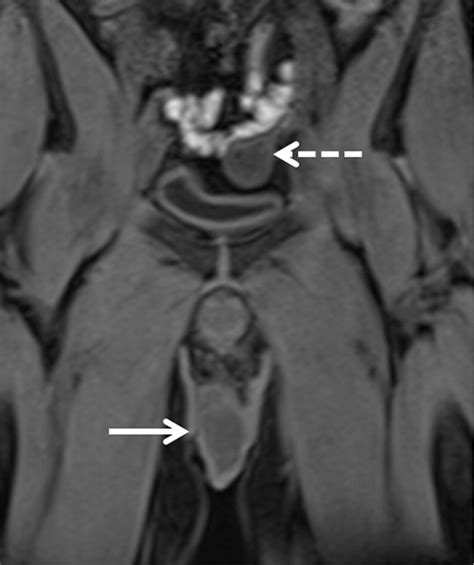 Testicular Tumors What Radiologists Need To Know—differential