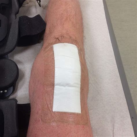 Quadriceps Tendon Rupture – Recovery phase 2 | swedanes.dk