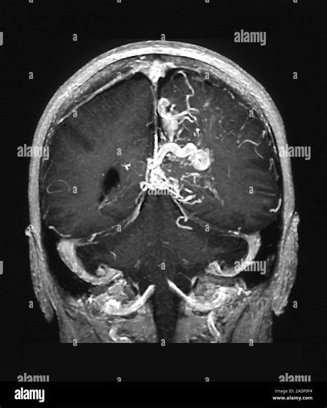 Malformación Arteriovenosa Cerebral Angiografía Por Resonancia