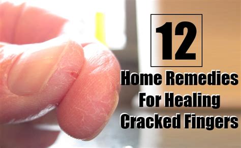 Top 12 Effective Home Remedies For Healing Cracked Fingers Morpheme