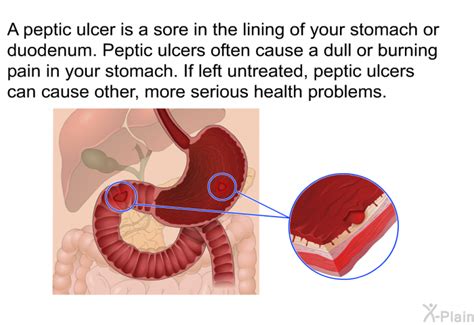 Peptic Ulcer