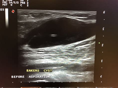 The Joint Clinic TM Barbotage Procedure